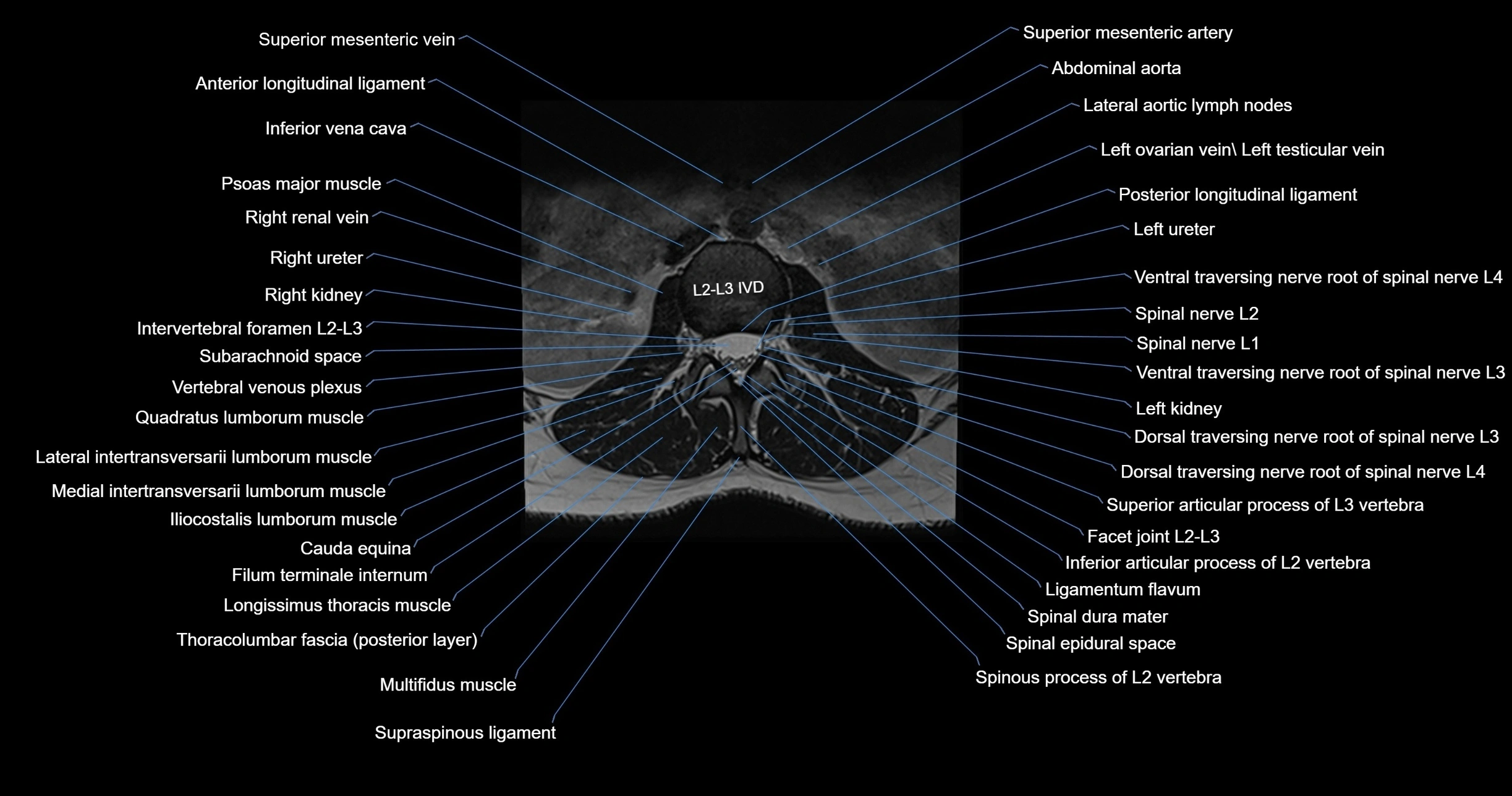 MRI lumbar spine axial cross sectional anatomy 3T radiology  image-img-00001-00019.webp